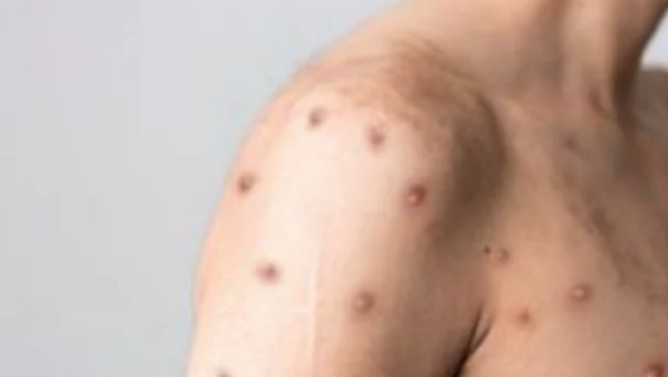 La OMS registra más de 26 mil casos de mpox en la primera mitad del año, la mayoría en África