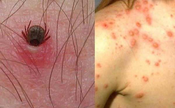 Registra SS 40 casos confirmados de rickettsiosis a nivel estatal; de éstos, 18 personas han perdido la vida