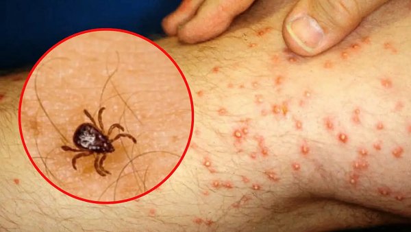 Van 28 casos de rickettsiosis en el estado; 11 personas perdieron la vida: SSE