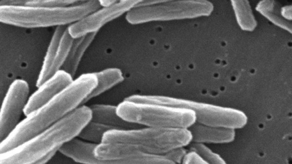 La tuberculosis en Estados Unidos alcanza su mayor nivel en más de 12 años