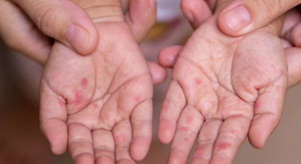 Se agrava brote de sarampión en Canadá: se registran 223 nuevos casos