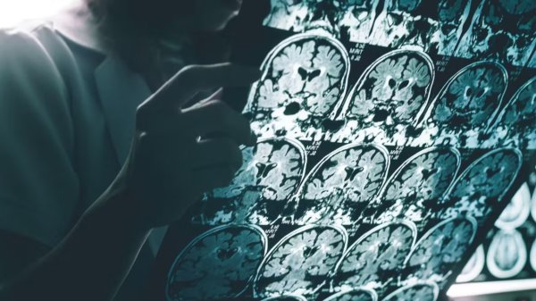 EU aprueba uso inédito del primer análisis de sangre para detectar Alzheimer