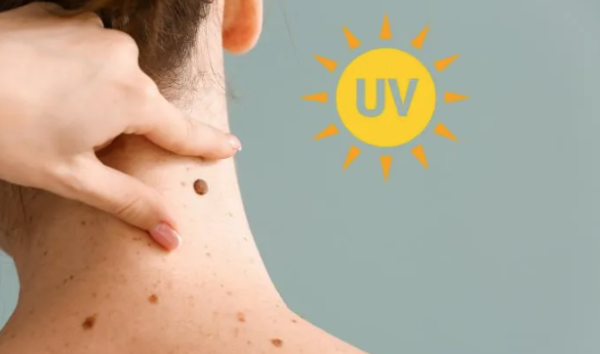Rayos UV causan mayoría de melanomas en el mundo, dice la OMS