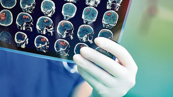 Necesario, reforzar acciones para mejorar atención del infarto cerebral en México, señalan especialistas