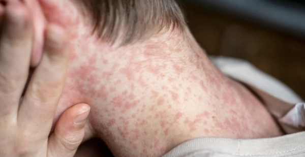 México reporta 74 casos activos de sarampión; hay 441 personas en fase de confirmación