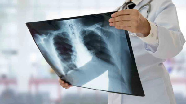 Los casos de tuberculosis bajan por primera vez desde la pandemia, pero se registran 1.23 millones de fallecimientos