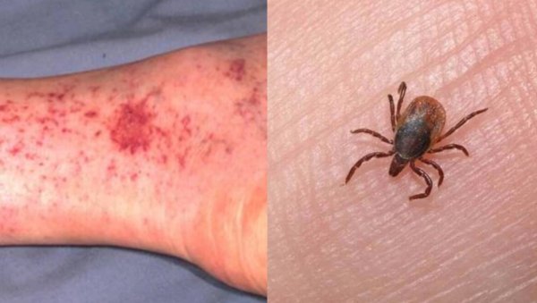 Aumentan a 105 los casos de rickettsiosis en Chihuahua; suman 50 defunciones