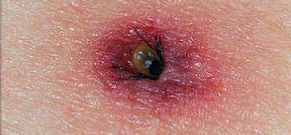 Confirma SSE 92 casos de rickettsia; 44 han perdido la vida