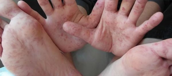 Se registra 62 casos de coxsackie en en estado: SSE