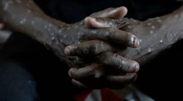 Congo declara fin de brote de mpox, tras dos años y más de 2 mil 200 muertes