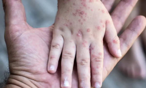 Repunte de sarampión deriva en suspensión de clases en escuelas de Jalisco y Aguascalientes