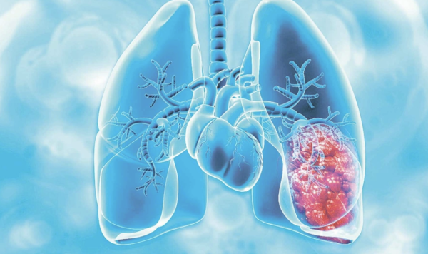 Nuevo León incorporará Inteligencia Artificial para detectar cáncer de pulmón en etapas tempranas