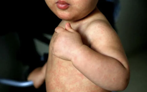 Sarampión es más contagioso que el covid-19: médico de la OPS