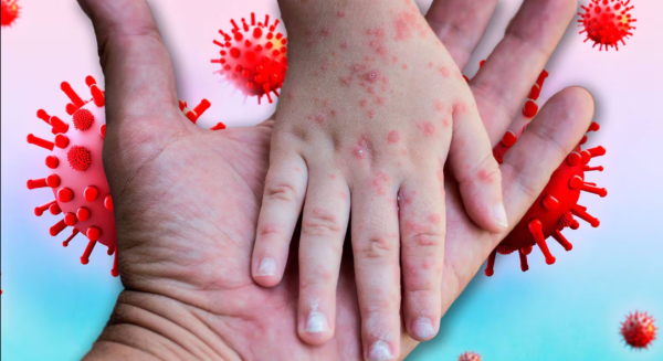 Sarampión en México: Salud reporta más de 8,000 casos y 27 defunciones a un año del primer brote