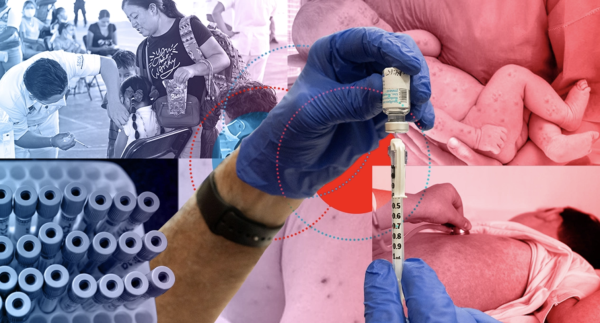Brote de sarampión en México: ¿Quiénes deben vacunarse y cómo prevenir contagios?
