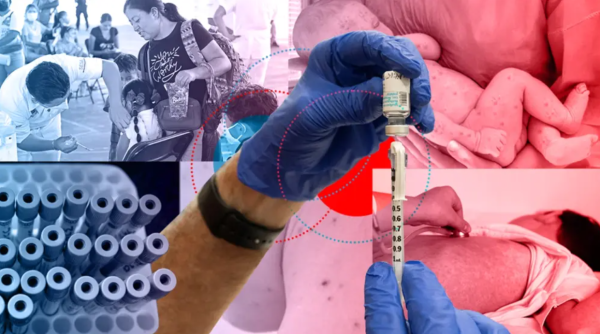 Sarampión: un solo caso puede generar hasta 20 contagios en México