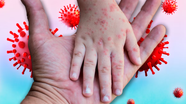 Sarampión en Tlaxcala: Muere un menor por complicaciones y falta de esquema de vacunación completo