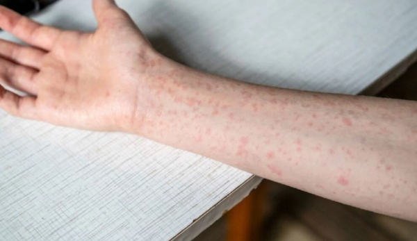 Carolina del Sur registra el peor brote de sarampión de los últimos 25 años en EU