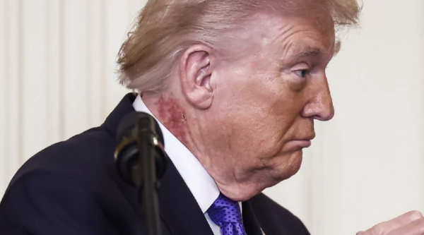 Trump presenta sarpullido en el cuello; su médico afirma que se trata de un tratamiento preventivo