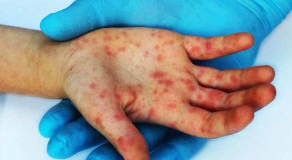 Asciende a 34 las personas fallecidas por sarampión; hay más de 12 mil 500 casos positivos