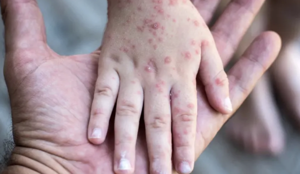 Sarampión en México: Aumentan a 34 las muertes y superan 12,000 los contagios